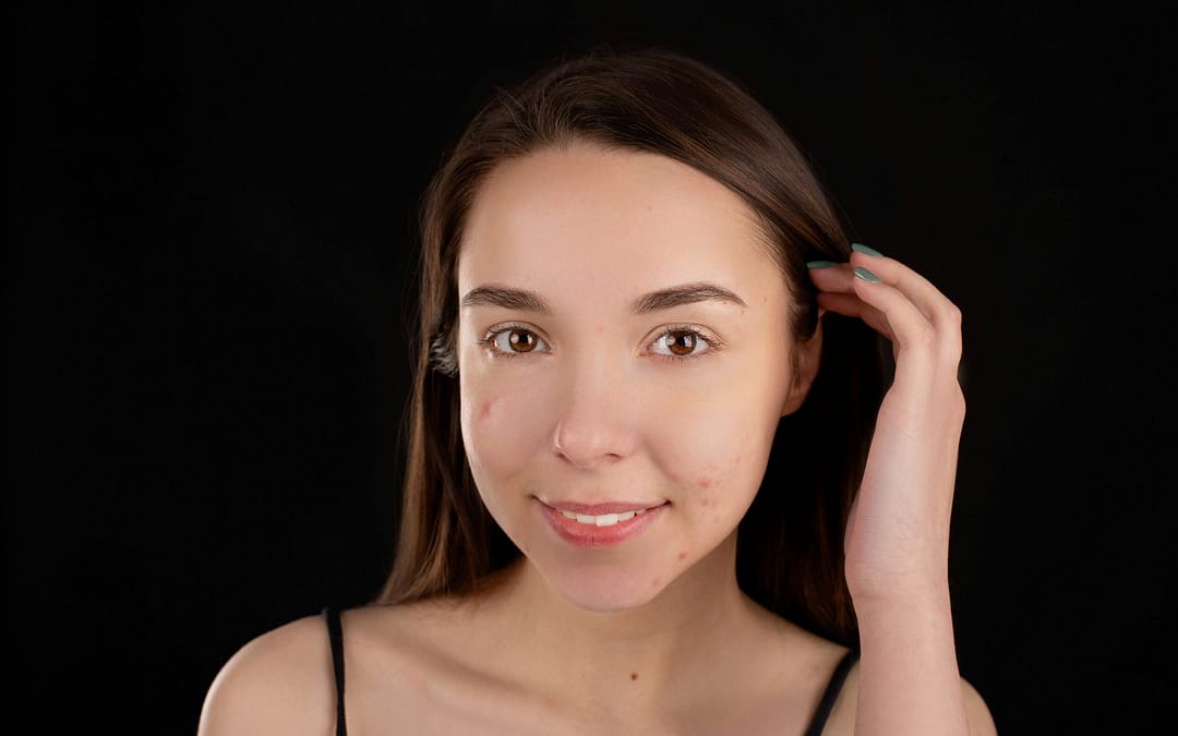 Most Popular Acne Scar Treatment & Therapies In Singapore