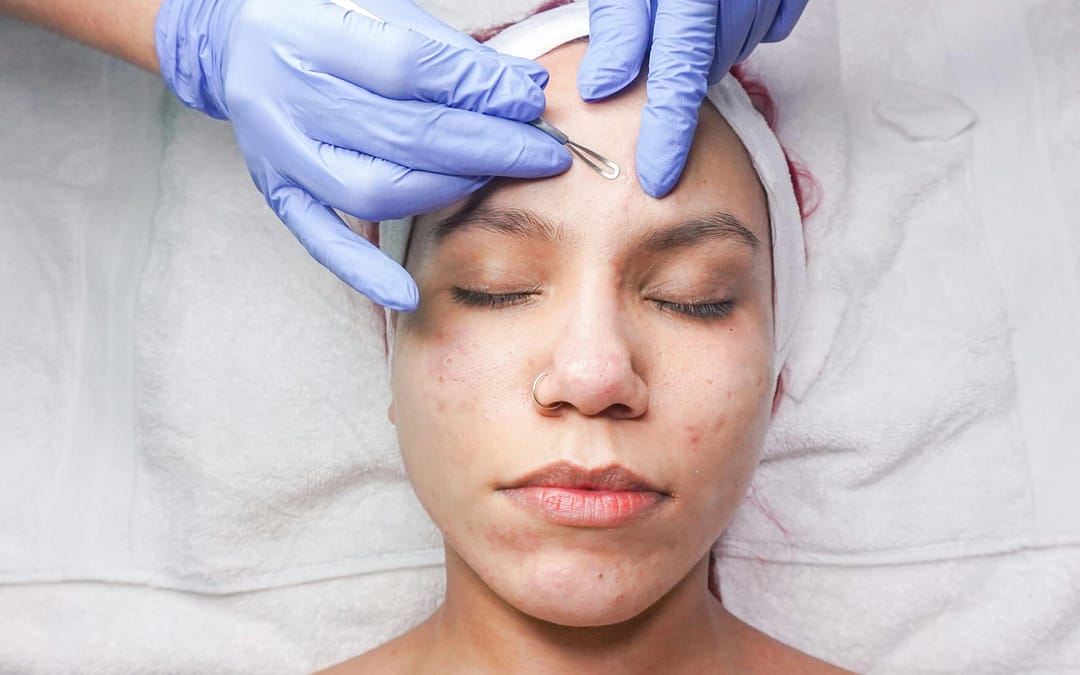 Treatment For Acne Scar In Singapore