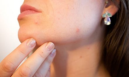 How To Treat Acne Scars While On Accutane?