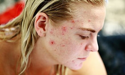 How To Treat Acne Scars At Home?