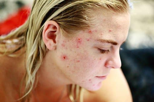 How To Treat Acne Scars At Home?